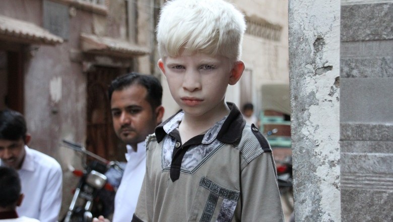 A Short History of Albinism