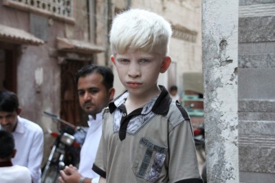 A Short History of Albinism