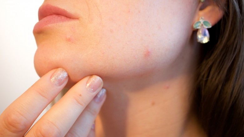 5 Steps to Eliminate Your Blackheads from Home