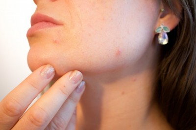 5 Steps to Eliminate Your Blackheads from Home