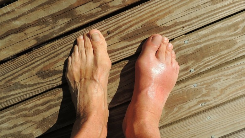 What Causes Swollen Ankles? - A Few Common Causes of Swelling Feet Or Ankle