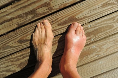 What Causes Swollen Ankles? - A Few Common Causes of Swelling Feet Or Ankle