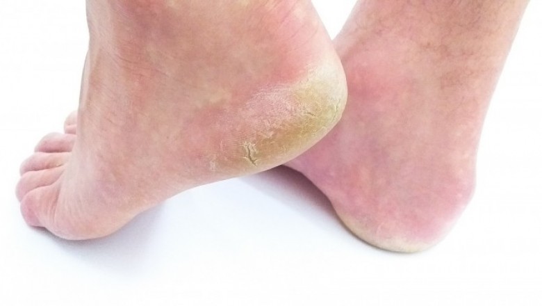 Skin Fungus Infections (Symptoms and Treatments)