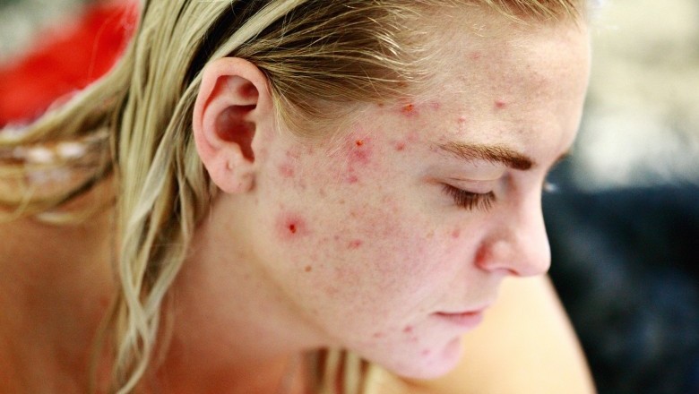 Mild, Moderate and Severe Acne - Whats Your Acne Stage ?