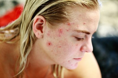 Mild, Moderate and Severe Acne - Whats Your Acne Stage ?