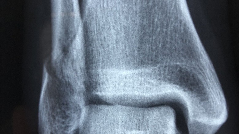 How To Treat A Sprained Ankle