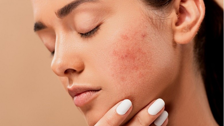 Is Glycolic Acid Good For Acne?