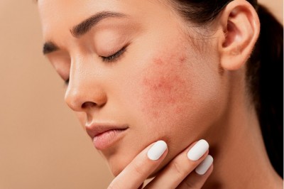 Is Glycolic Acid Good For Acne?