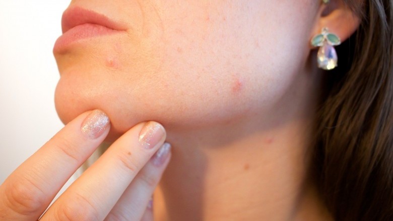 How the Liver Prevents Acne